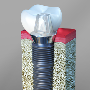 Dental Implants Linden