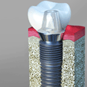 A Comprehensive Guide to Dental Implants in Linden
